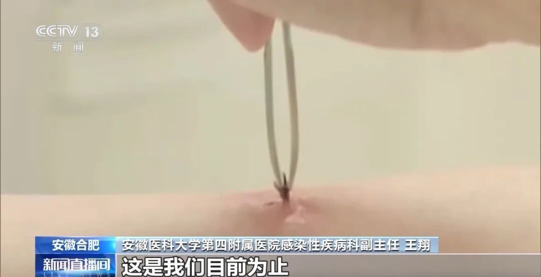 一人身上拔出17只蜱虫！被叮咬后绝对不要这样处理→