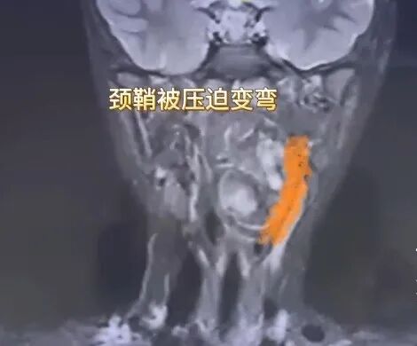 6岁男孩夜间打鼾，医生见到影像报告惊了：“双胞胎兄弟”残留在咽喉……