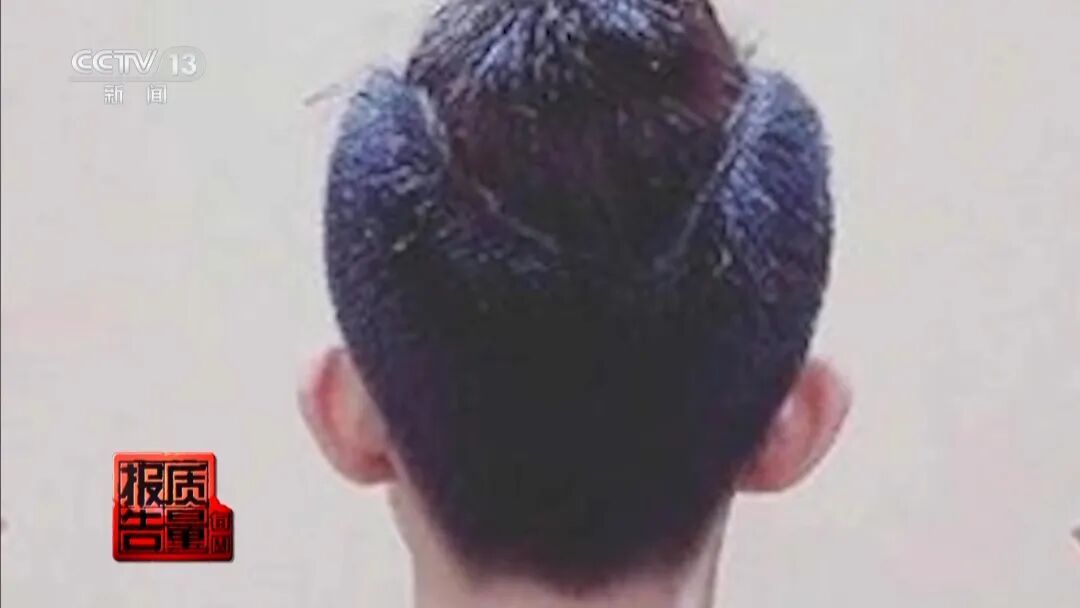 “精灵耳”背后的整形乱象：女子注射后落下终身残疾……