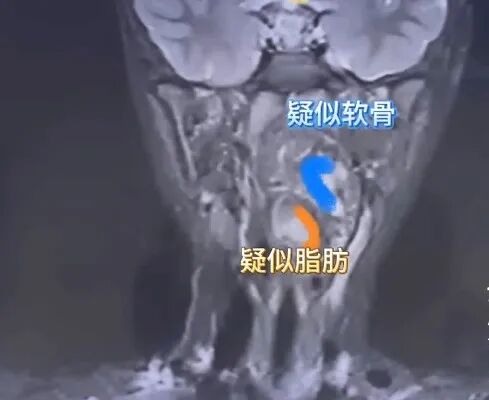 6岁男孩夜间打鼾，医生见到影像报告惊了：“双胞胎兄弟”残留在咽喉……