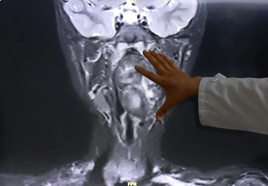 6岁男孩夜间打鼾，医生见到影像报告惊了：“双胞胎兄弟”残留在咽喉……