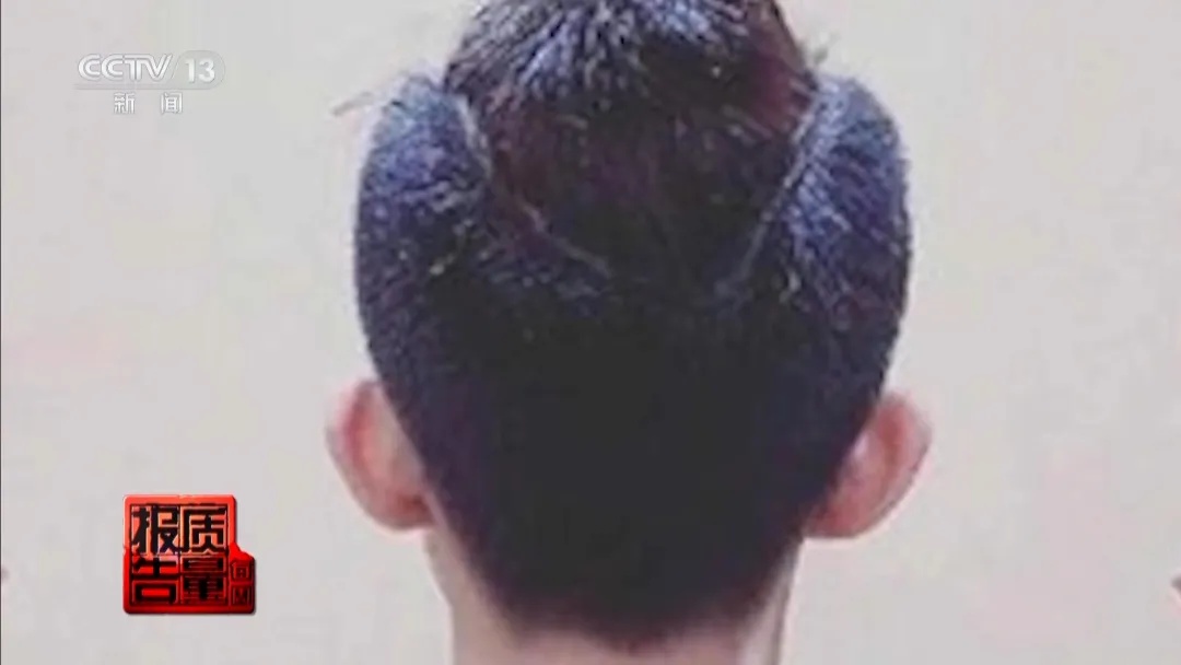 女子注射后落下终身残疾！央视曝光“精灵耳”整形乱象，所谓的小脸神器实为医学伪概念