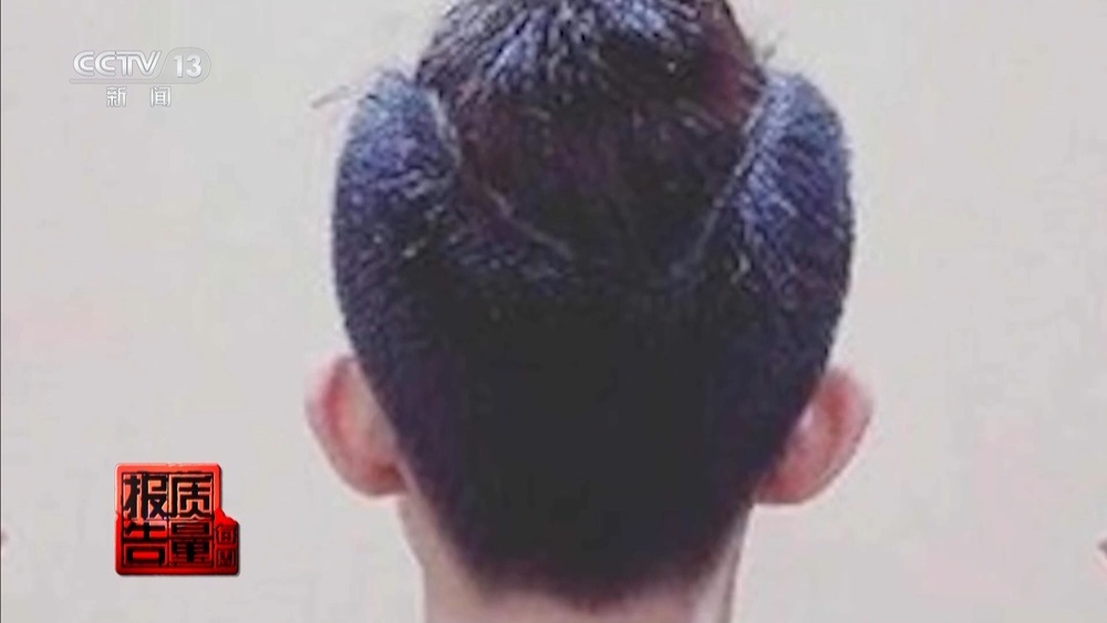 每周质量报告丨“麻药一过，生不如死” 揭秘“精灵耳”整形乱象