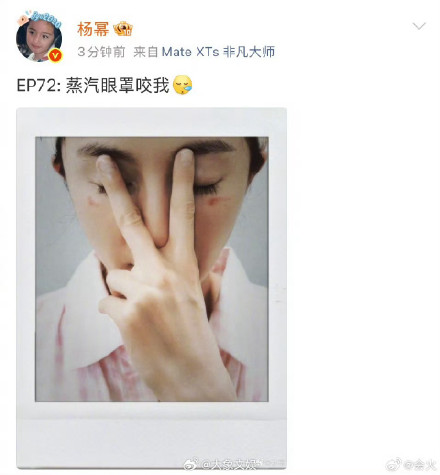 医生回应杨幂脸被蒸汽眼罩烫伤：蒸汽眼罩不是“零风险”的