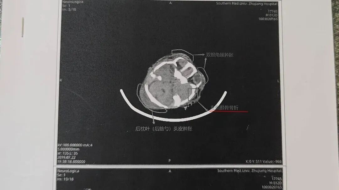 广州一男孩被医院当脑瘫治7年，父母偶然发现病历疑点，已向法院提起诉讼