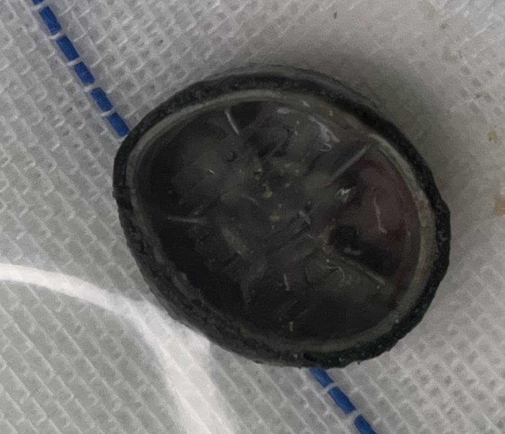 6岁女孩下体反复出血，长达4年！去医院检查…家长惊呆︎