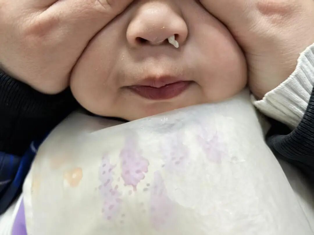 连续2例！最小的才18个月…只因一个小动作，差点“窒息”