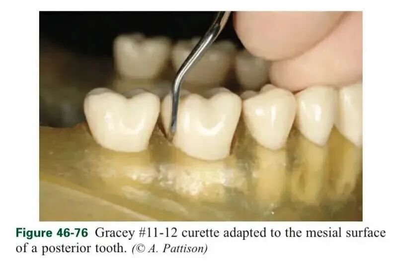 健康 | 一种会让牙齿掉光的病，很多人年轻时不重视，到老了就后悔了……