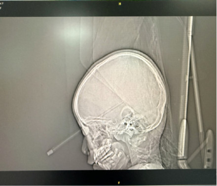 20厘米长的铅笔从眼眶扎入女童大脑，这类文具别乱买