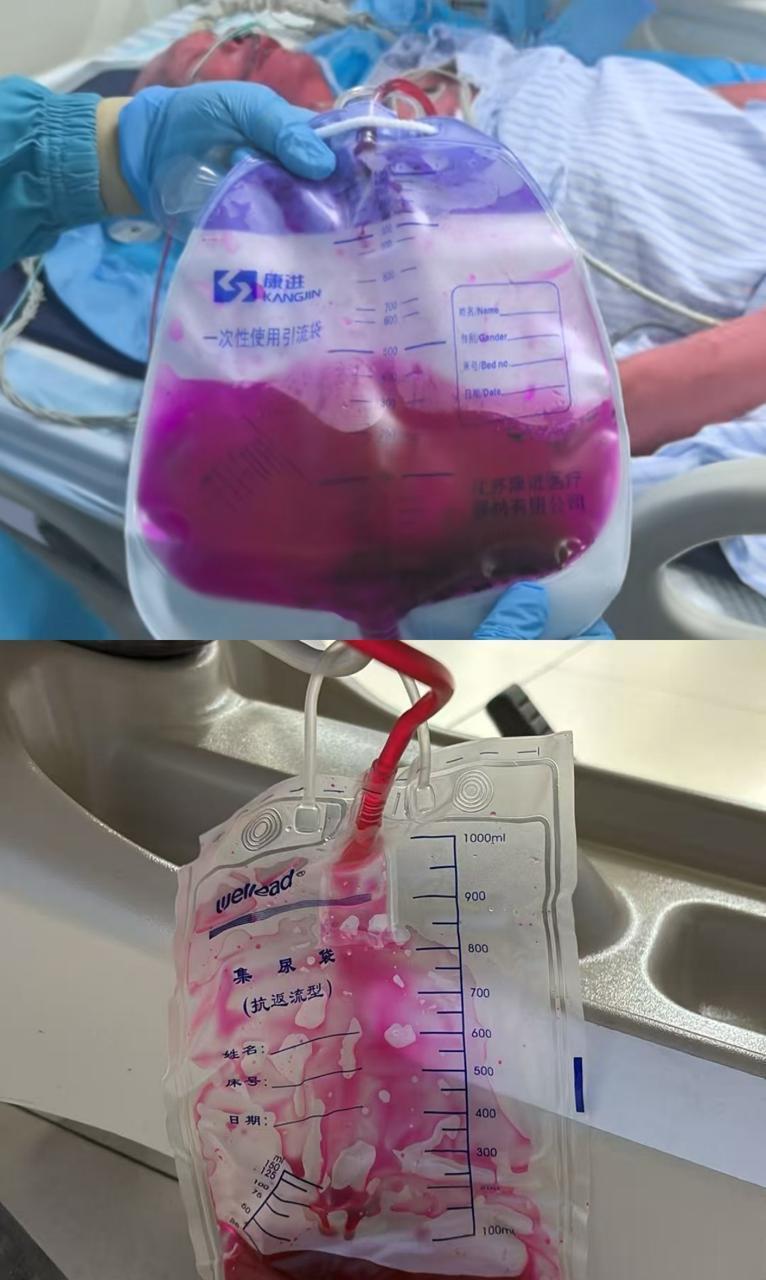 患阿尔兹海默症老人误食染料变“小红人”，医生：从医30余年首次遇到此类病例