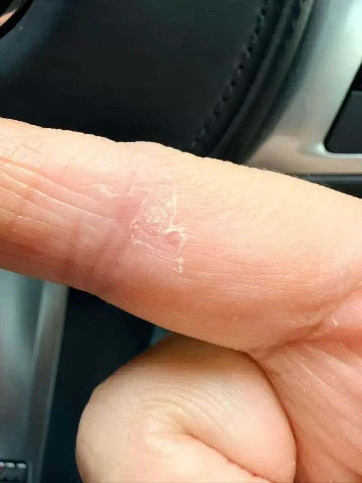 “痒到怀疑人生！”女子朋友圈一张照片炸了：原来这么多人都有？