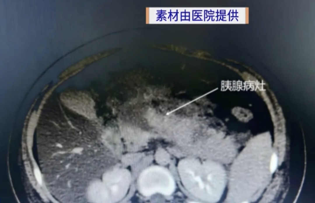 一顿6个鸡腿+几大块红烧肉，14岁男孩暴饮暴食险丧命！医生提醒