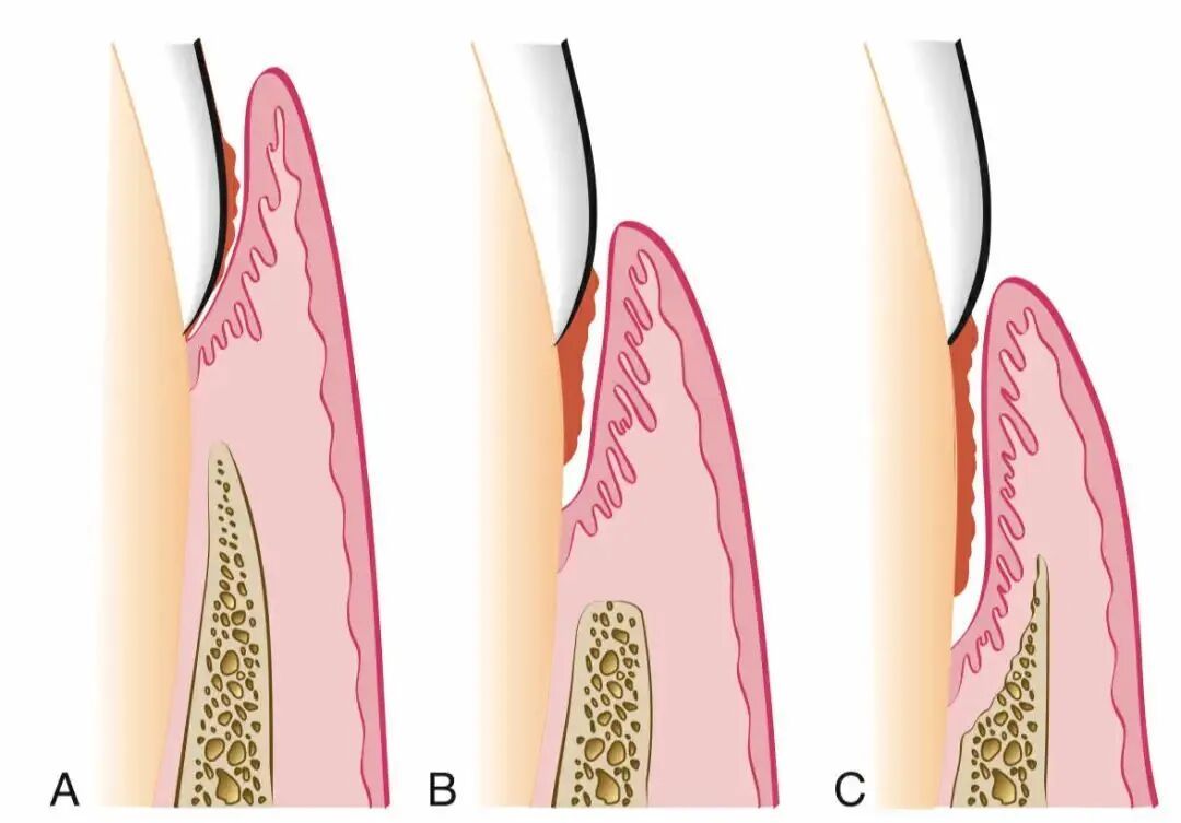 健康 | 一种会让牙齿掉光的病，很多人年轻时不重视，到老了就后悔了……