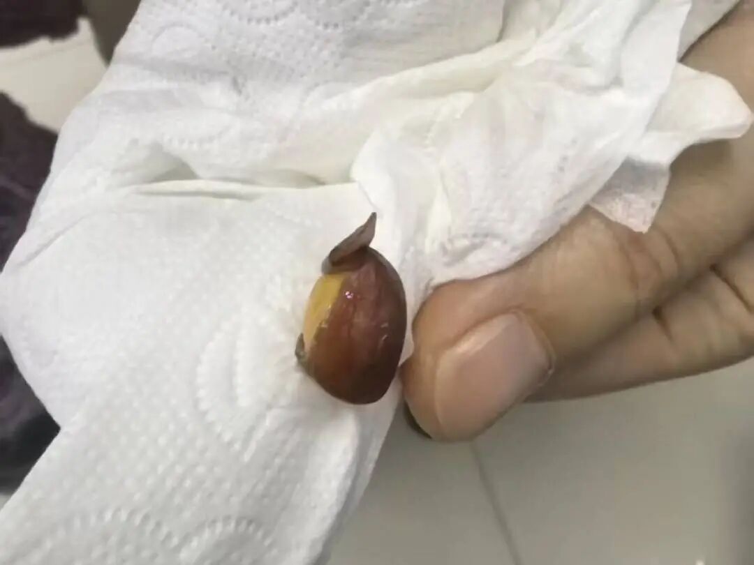 连续2例！最小的才18个月…只因一个小动作，差点“窒息”