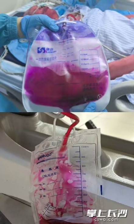 男子误食染料全身变红