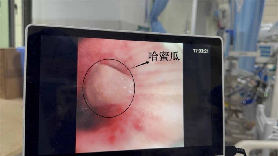 一块哈密瓜差点要了71岁老人的命，呼吸科专家：这类人群进食一定要警惕