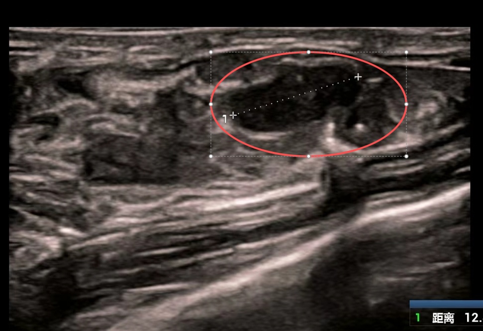 触目惊心！18岁女孩双乳“爆发”84个肿块，最大的如鹅蛋！这些习惯立刻改掉️