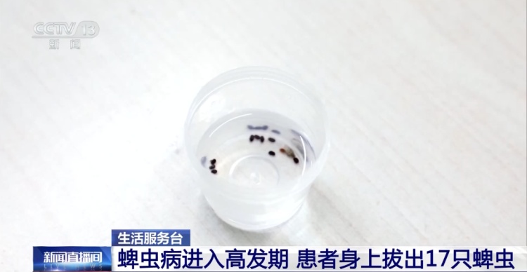 高烧不退，医生从患者身上拔出17只蜱虫！