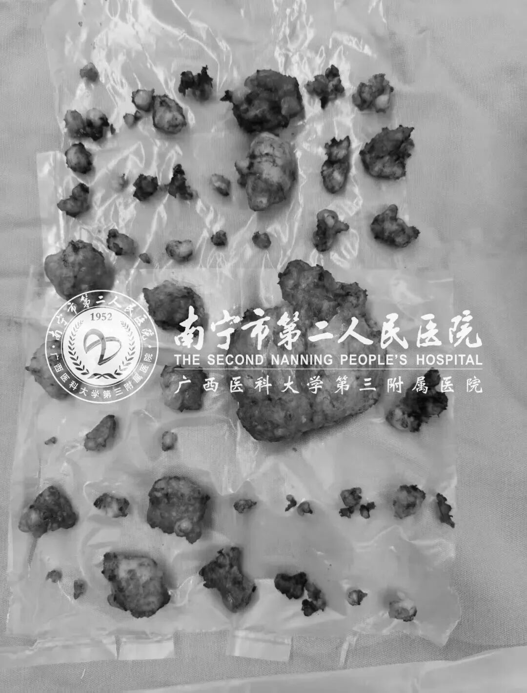 触目惊心！18岁女孩双乳“爆发”84个肿块，最大的如鹅蛋！这些习惯立刻改掉️