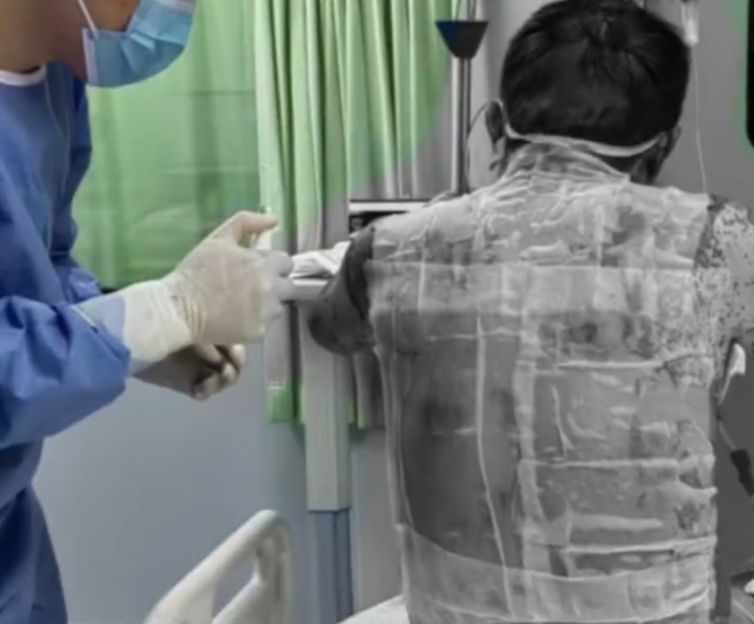 35岁男子酒后3次服用布洛芬，全身95%溃烂，“像被开水烫过”，一度生命垂危...