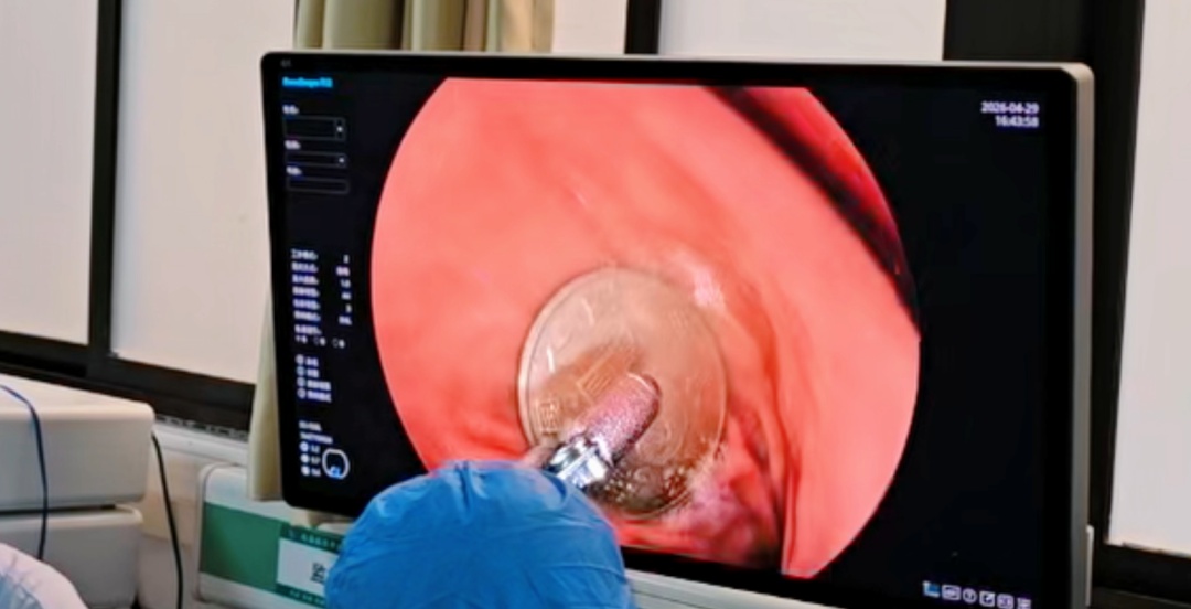 又一起！佛山2岁宝宝误吞硬币，咽喉卡阻险酿大祸！