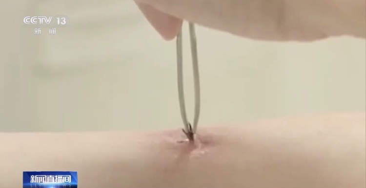 高烧不退，医生从患者身上拔出17只蜱虫！