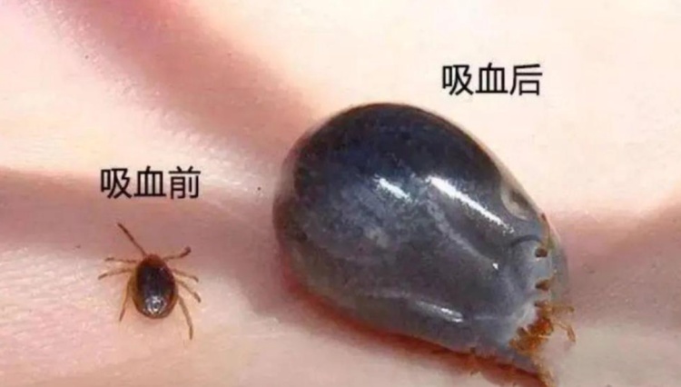 高烧不退，医生从患者身上拔出17只蜱虫！