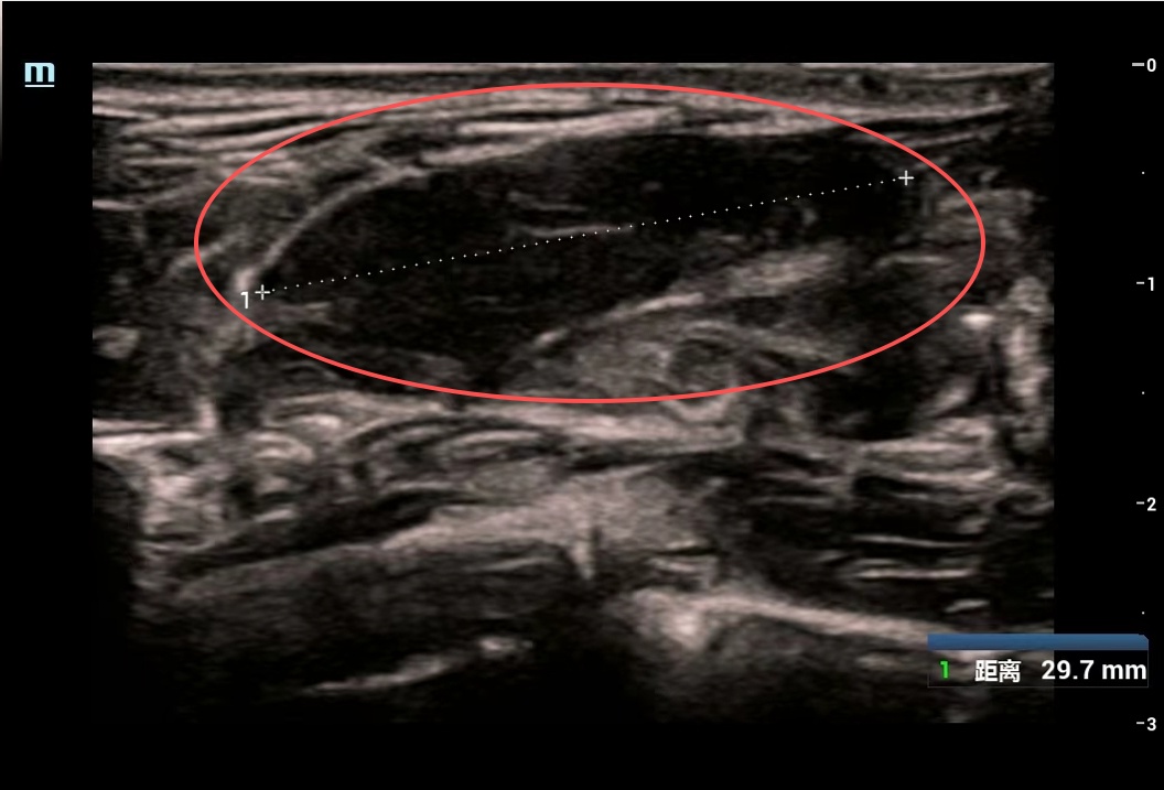 触目惊心！18岁女孩双乳“爆发”84个肿块，最大的如鹅蛋！这些习惯立刻改掉️