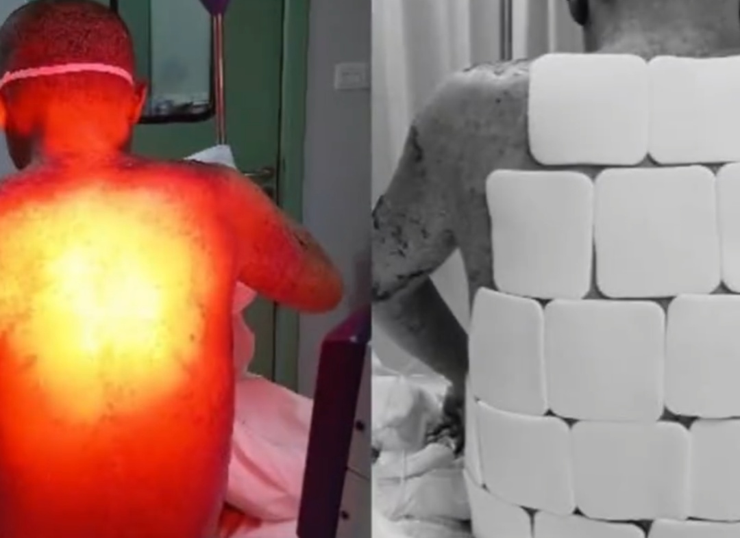 35岁男子酒后3次服用布洛芬，全身95%溃烂，“像被开水烫过”，一度生命垂危...