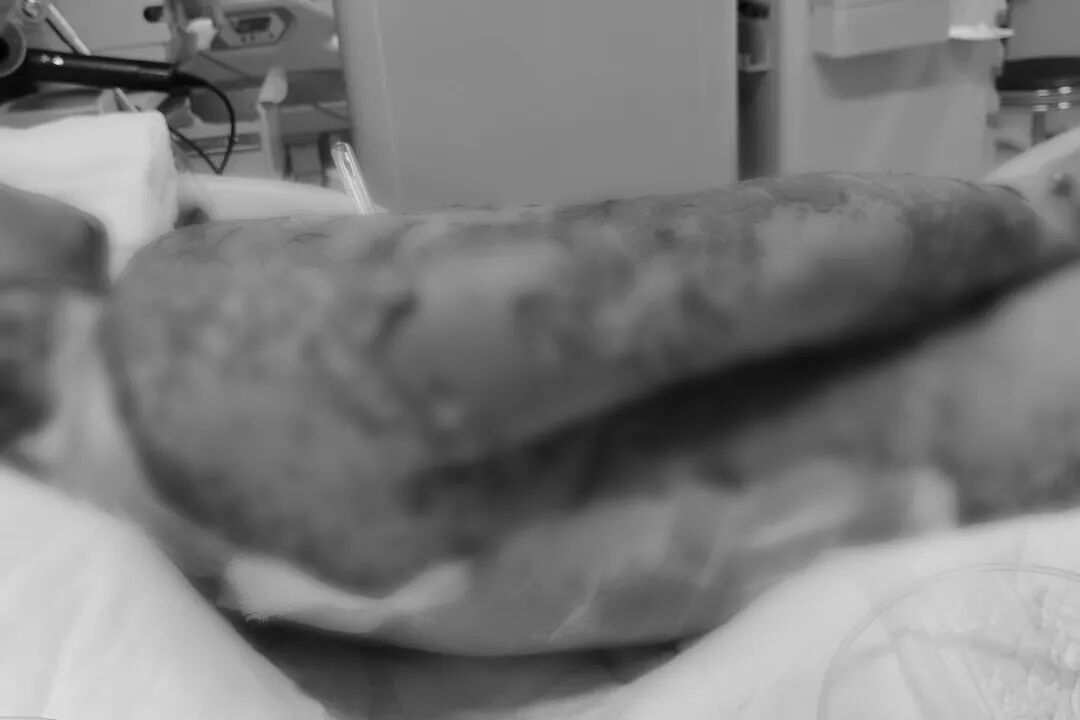 35岁男子喝酒后头疼，连吃3次布洛芬，全身95%以上皮肤溃烂！“像被开水烫过”