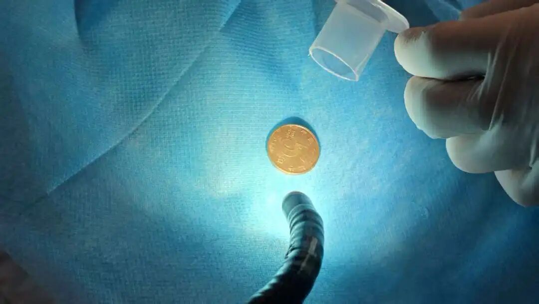 又一起！佛山2岁宝宝误吞硬币，咽喉卡阻险酿大祸！