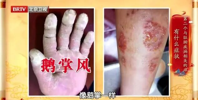 这种痒是高血糖信号，用它泡水，快速止痒，简单有用