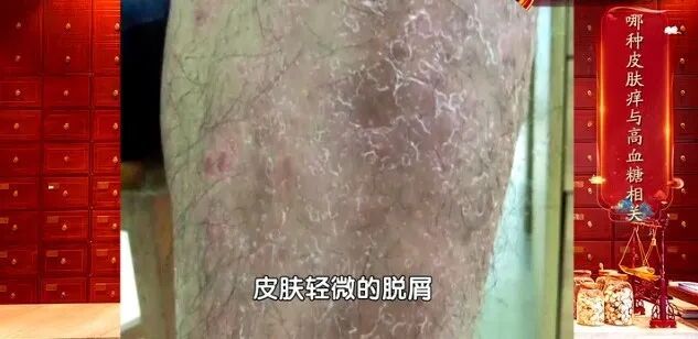 这种痒是高血糖信号，用它泡水，快速止痒，简单有用