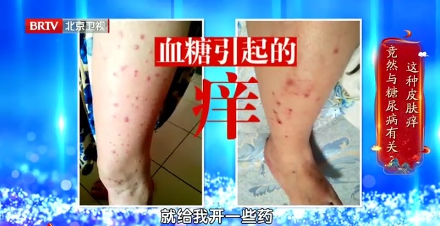 这种痒是高血糖信号，用它泡水，快速止痒，简单有用
