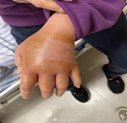 70岁阿姨被鱼刺扎伤 手肿成气球