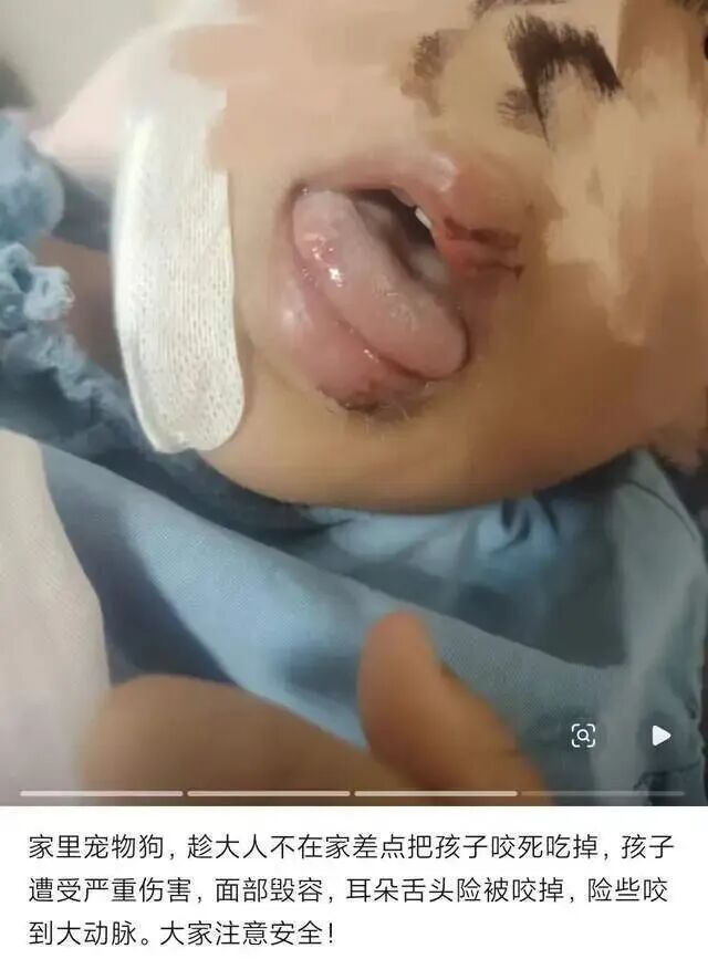 太吓人！5岁男童被自家养了几年的哈士奇咬伤面部，缝了近50针