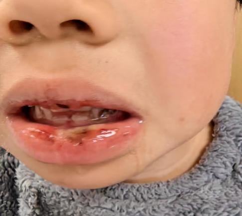多名孩子误服管道疏通剂！医生紧急提醒：错误急救等于二次伤害，后果不可逆