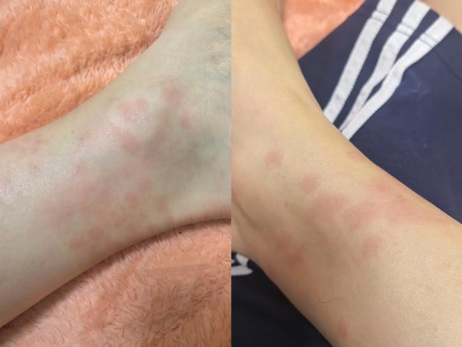 密密麻麻，天气一热就猛增！不少人中招，痒到抓狂