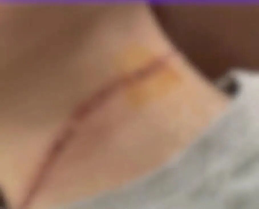 有人已被割脸！警惕“隐形杀手”风筝线