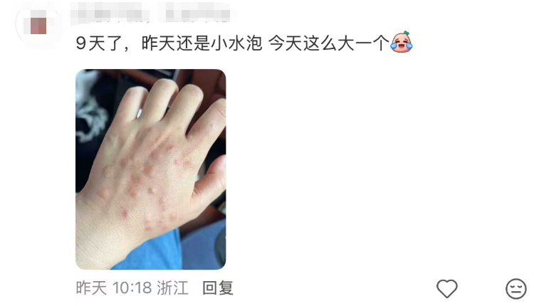 头皮发麻！女子出了一趟门，腿上密密麻麻长满...近期猛增，不少人已中招！