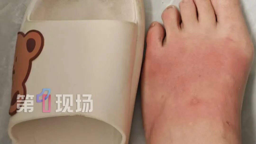 爱穿拖鞋的广东人注意！有人穿完红肿一片，这病夏季更常见…