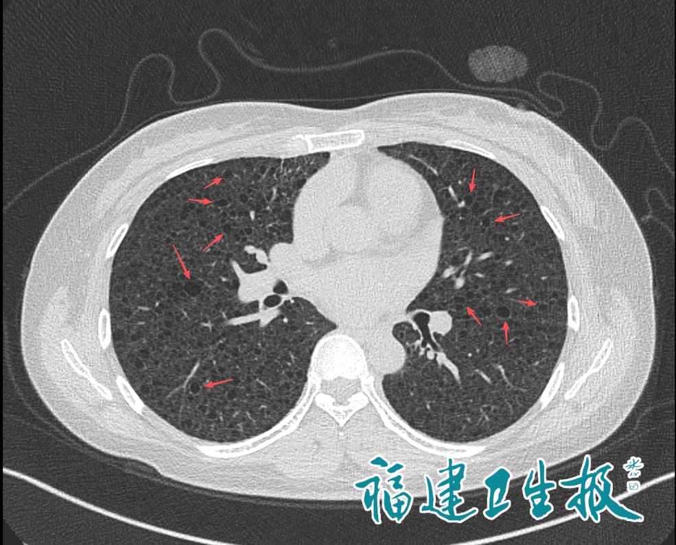 90后前运动员双肺长满囊泡，两年前起反复胸闷气喘