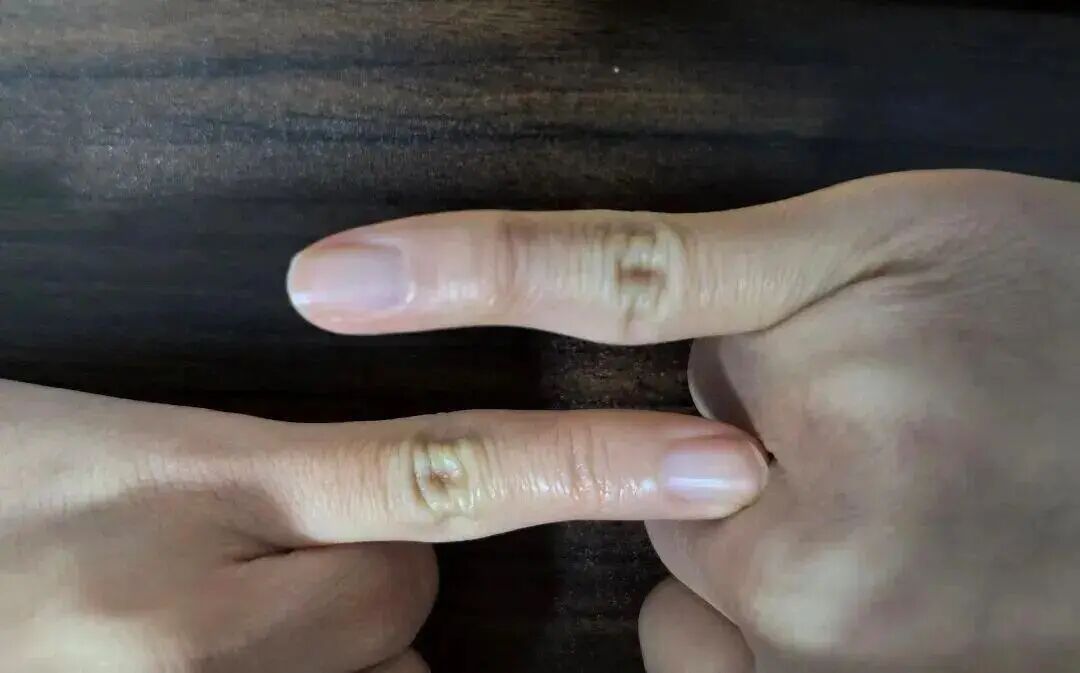 你是不是正在用小拇指当“手机支架”？快改！