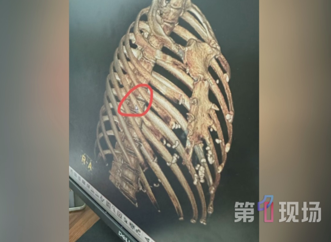 74岁老太按摩店“松骨”，回家后疼到无法翻身！医生一查：肋骨骨折