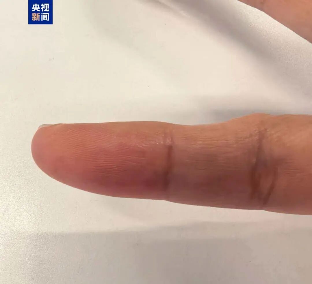 你是不是正在用小拇指当“手机支架”？快改！