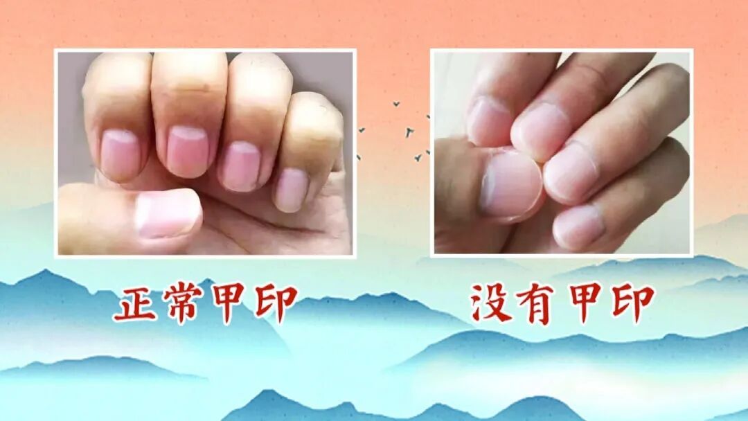 指甲月牙越多，阳气越旺，血脉循环越好？教你两招，扶阳又延寿