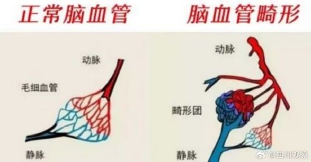 小伙撸铁猛发力触发颅内隐患