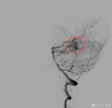 小伙撸铁猛发力触发颅内隐患