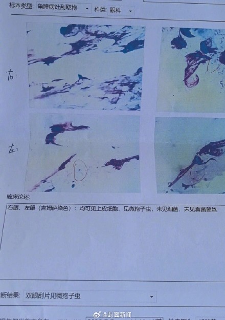 女子养鹦鹉20天 眼部感染寄生虫