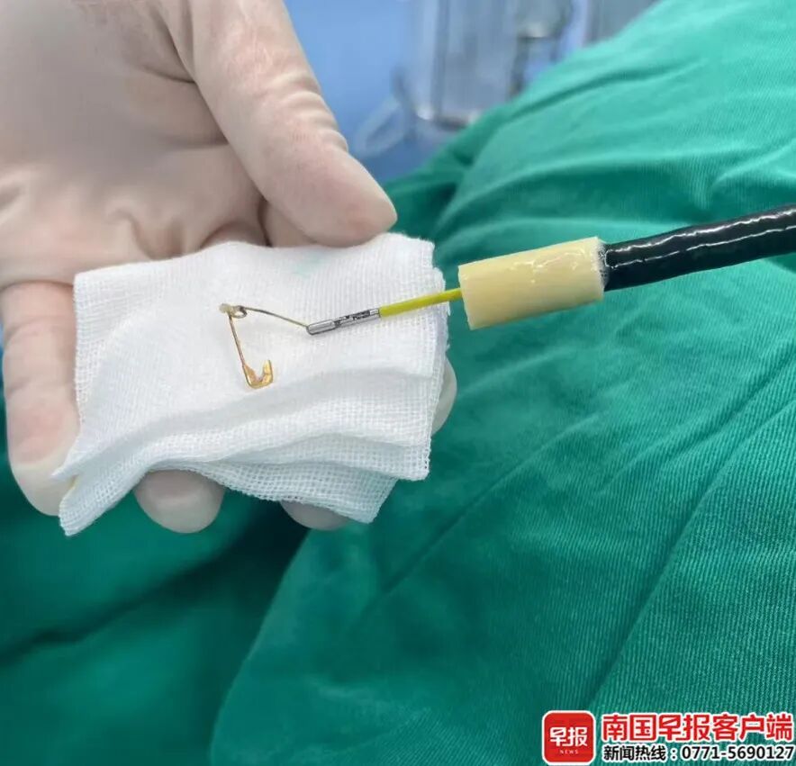 北海一名7个月大的宝宝反复咳嗽发热，医生紧急手术，从食管内取出一枚尖锐别针！